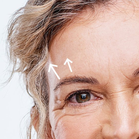 Augenbrauenlift &ndash; Brauen- und Augenpartie